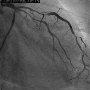 冠状动脉造影